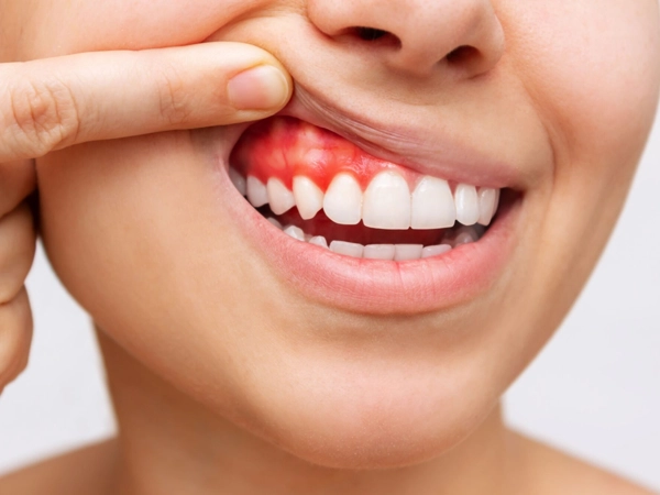 Cannabis na Periodontite