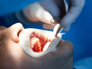Hidrogel de CBD no tratamento periodontal